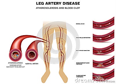 Leg artery disease, Atherosclerosis Vector Illustration