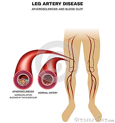 Leg artery disease, Atherosclerosis Vector Illustration