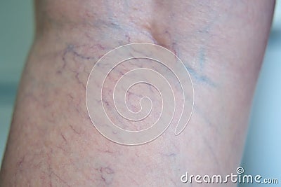 Leg close up with incipient varicose veins Stock Photo