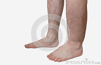 Leg of diseased patient who suffers from Edema Stock Photo