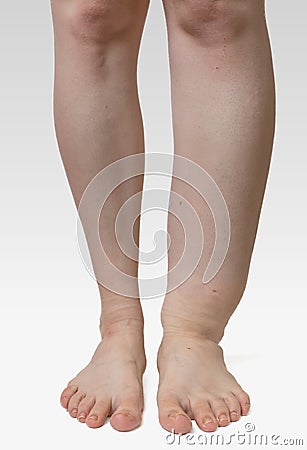 Leg of diseased patient who suffers from Edema Stock Photo