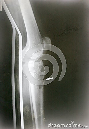 Leg fracture x-ray Stock Photo