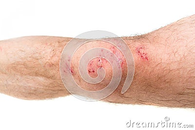 Leg of a man injured in a motorbike Stock Photo