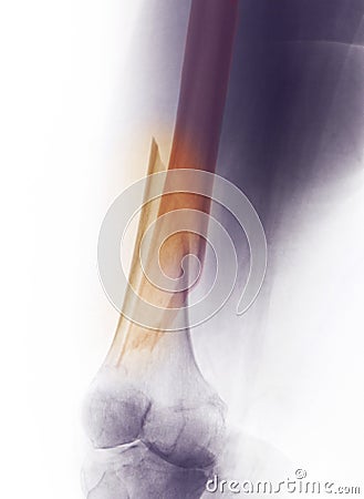 Leg X-ray, fracture of distal femur Stock Photo