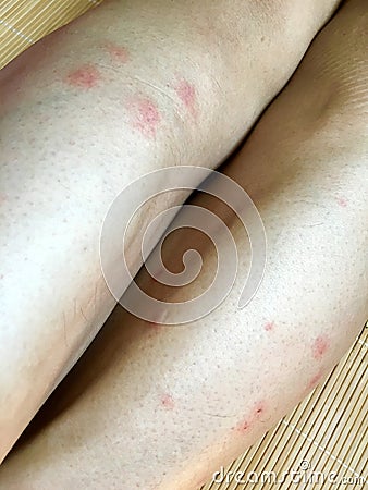 Legs bitten by mosquitoes Stock Photo