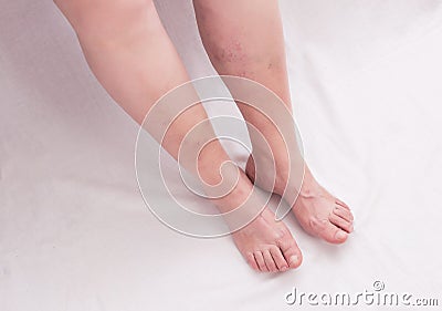 Legs of an old woman on a white background with varicose veins on the legs, phlebeurysm, anatomy Stock Photo