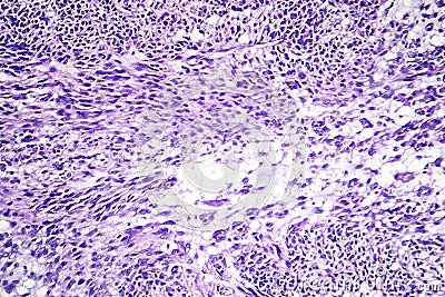 Leiomyoma, or fibroids, is a benign smooth muscle tumor Stock Photo