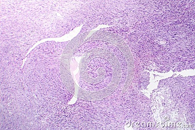 Leiomyosarcoma, a malignant cancerous smooth muscle tumor Stock Photo