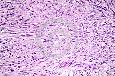 Leiomyosarcoma, a malignant cancerous smooth muscle tumor Stock Photo