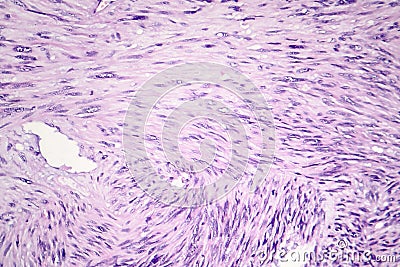 Leiomyosarcoma, a malignant cancerous smooth muscle tumor Stock Photo