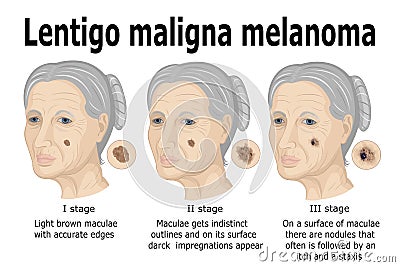 Lentigo maligna melanoma Vector Illustration