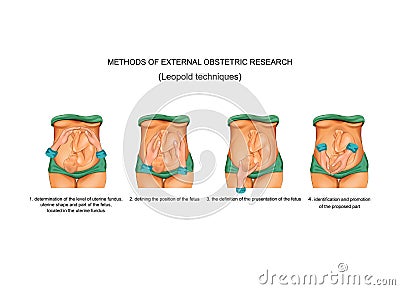 Leopold techniques in obstetrics Vector Illustration