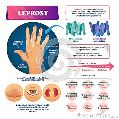 Leprosy vector illustration. Labeled medical bacterial infection disease. Vector Illustration