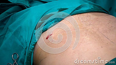 Lesion after doctor use a surgery blade open surgery area,fat re Stock Photo