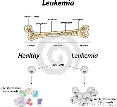 Leukemia Bone Vector Illustration