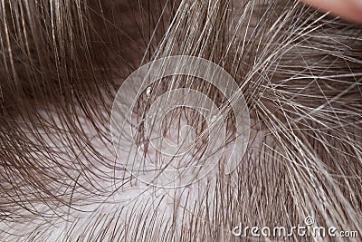 Lice Stock Photo