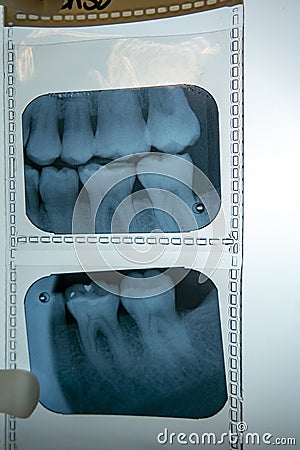 Dentist left side of human first and second molars teeth x-ray scan on a light box Stock Photo