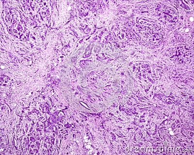 Human breast malignant carcinoma Stock Photo