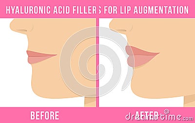 Lip augmentation effects Vector Illustration