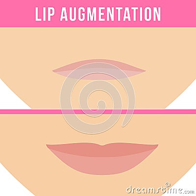 Lip augmentation effects Vector Illustration
