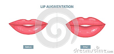 Lip Augmentation. Before and after lip filler injections. Vector Vector Illustration