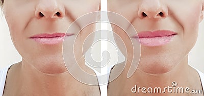 Lip augmentation before and after procedures, filler Stock Photo