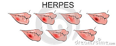 Lip herpes. bladder, inflammation Vector Illustration