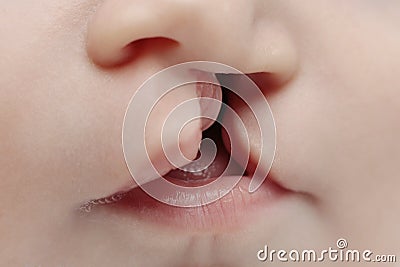 Lip and palate cleft Stock Photo