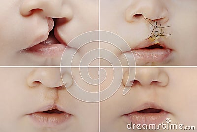 Lip and palate cleft before and after surgery Stock Photo