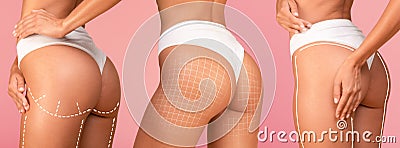 Lipolysis Treatment. Collage With Female In Underwear With Perfect Buttocks Stock Photo