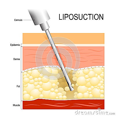 Liposuction. Cannula into the fat layer beneath skin. Vector Illustration