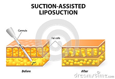 Liposuction Vector Illustration