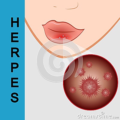 Lips closeup with cold herpes, sore on the lip Vector Illustration