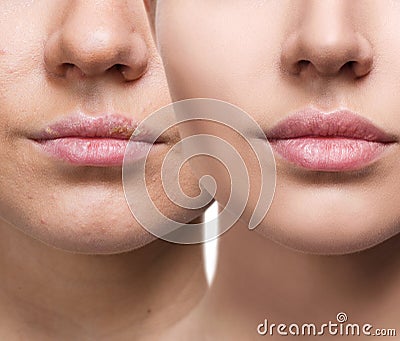 Lips with herpes before and after treatment. Stock Photo