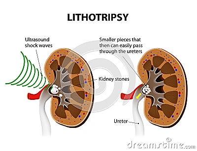 Lithotripsy Vector Illustration