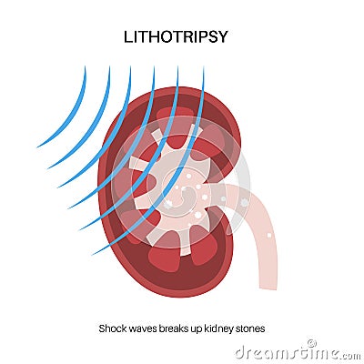 Lithotripsy procedure concept Vector Illustration