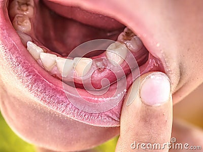 Little boy showing that he lost first milk canine tooth Stock Photo
