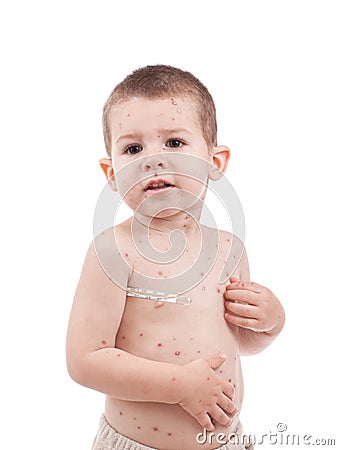 Little boy whit smallpox Stock Photo