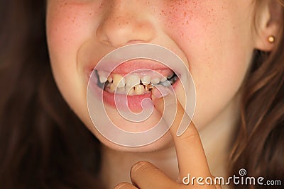 little girl opens her mouth and shows a sick tooth. caries on a baby tooth. Care for children's teeth. Damaged tooth Stock Photo