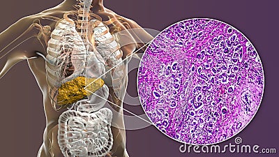 Liver with biliary cirrhosis Cartoon Illustration