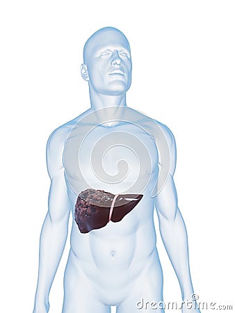 liver cancer Cartoon Illustration