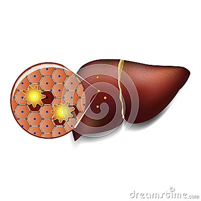 Liver Cells Attacked by Toxins Vector Illustration