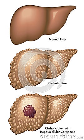 Liver with cirrhosis and carcinoma Vector Illustration