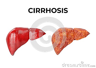 Liver cirrhosis is a chronic inflammation of the liver, a fibrous tissue replaces normal liver tissue, blocking blood flow Cartoon Illustration