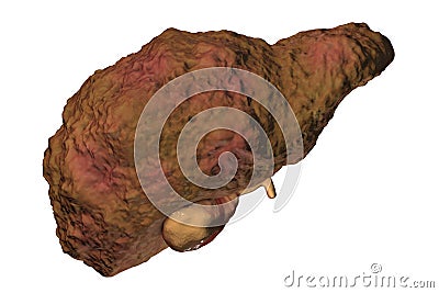 Liver cirrhosis illustration Cartoon Illustration