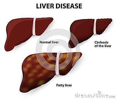 Liver Disease Vector Illustration