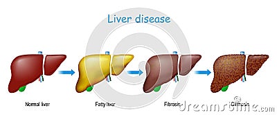 Liver disease. From healthy internal organ to Fatty liver, fibrosis, and Cirrhosis Vector Illustration