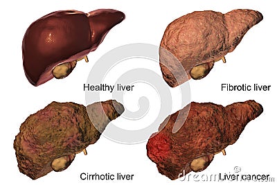 Liver disease progression in Hepatitis B and C viral infection Cartoon Illustration