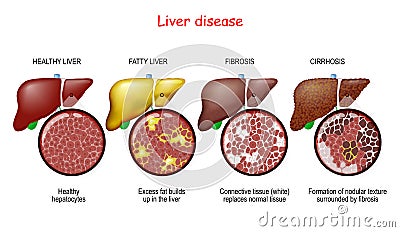 Liver diseases. Stages of liver damage Vector Illustration