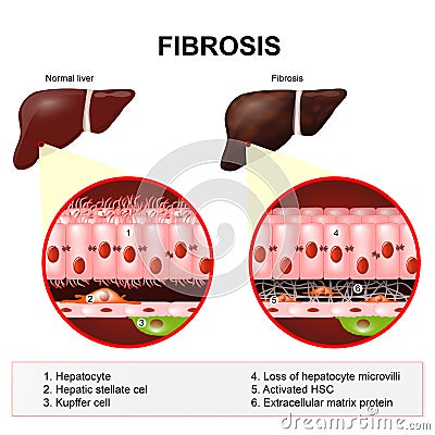 Liver fibrosis Vector Illustration